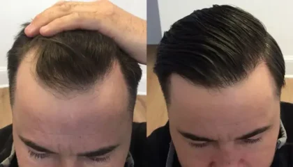 HHH Natural Hair Transplant Center
