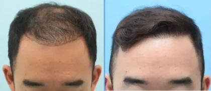 HHH Natural Hair Transplant Center