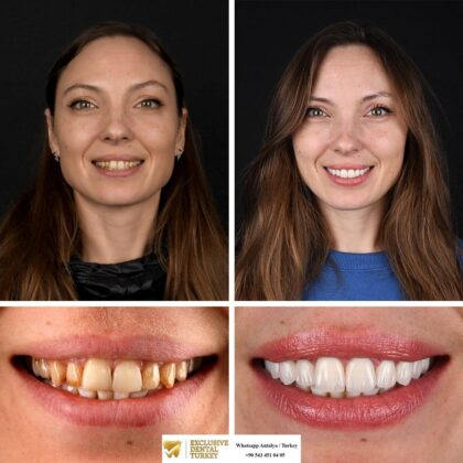 Exclusive Dental Turkey | Antera
