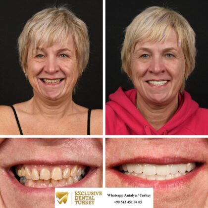 Exclusive Dental Turkey | Antera