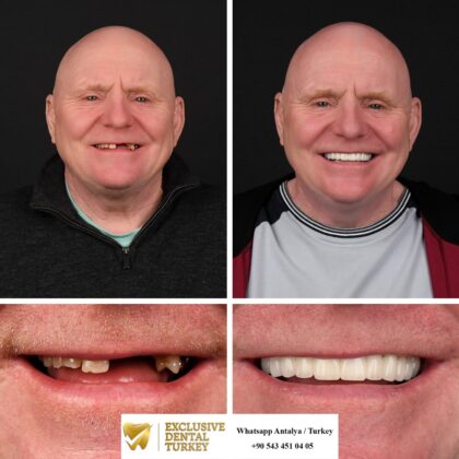 Exclusive Dental Turkey | Antera
