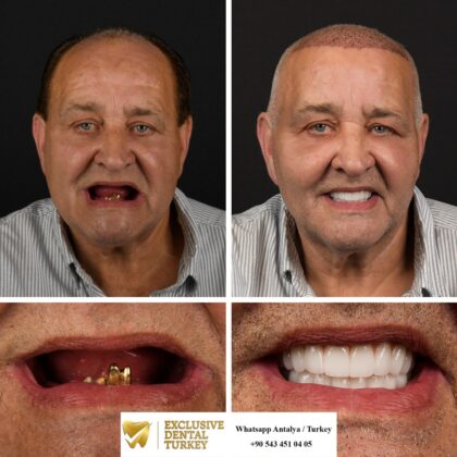 Exclusive Dental Turkey | Antera