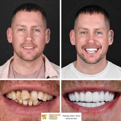 Exclusive Dental Turkey | Antera