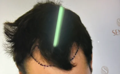 Seneca Hair Restoration UK