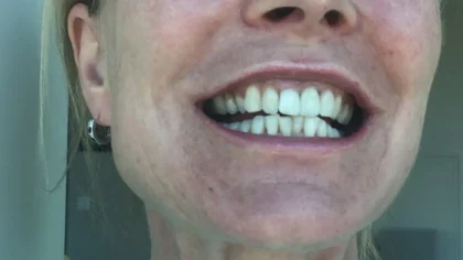 Dental Implants Costa Rica
