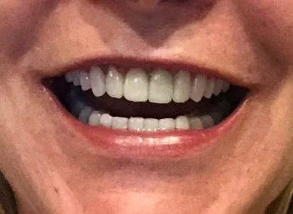 Dental Implants Costa Rica