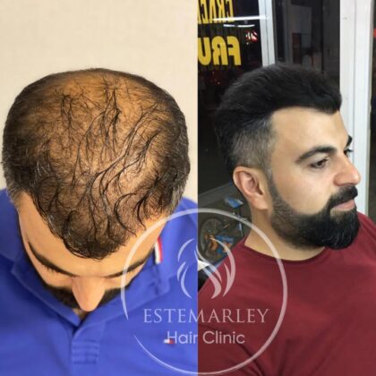 Estemarley | Hair Clinic Estemarley | Hair Clinic
