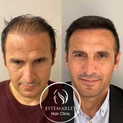 Estemarley | Hair Clinic Estemarley | Hair Clinic