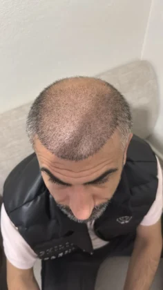 Estemarley | Hair Clinic Estemarley | Hair Clinic