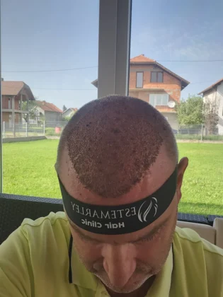 Estemarley | Hair Clinic Estemarley | Hair Clinic