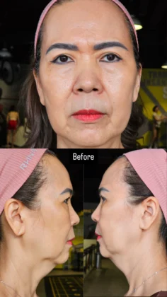RNWOOD Plastic Surgery