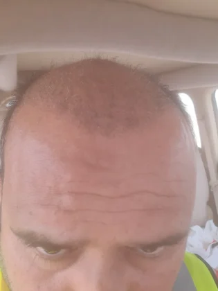 Dr. Ziya Yavuz Hair Transplant Clinic