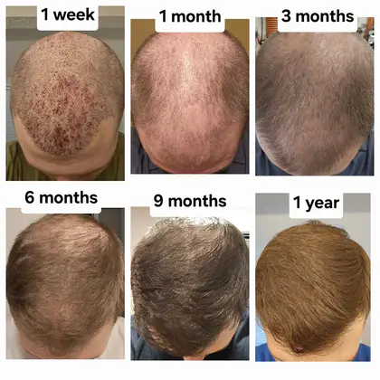 UnitedCare Hair Transplant Clinic