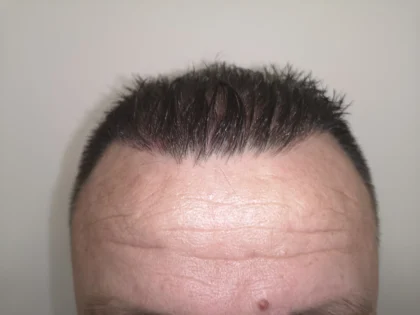 Clinista Hair Transplant Center Clinista Hair Transplant Center