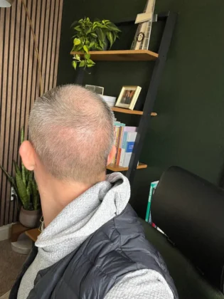 Dr. Ziya Yavuz Hair Transplant Clinic