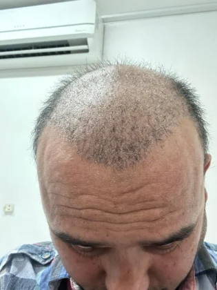 Dr. Ziya Yavuz Hair Transplant Clinic