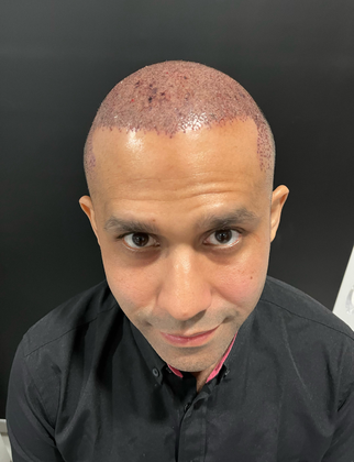 UnitedCare Hair Transplant Clinic