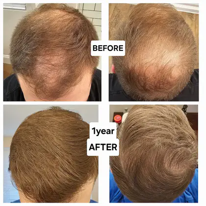 UnitedCare Hair Transplant Clinic