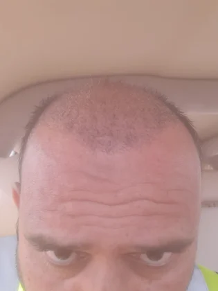 Dr. Ziya Yavuz Hair Transplant Clinic