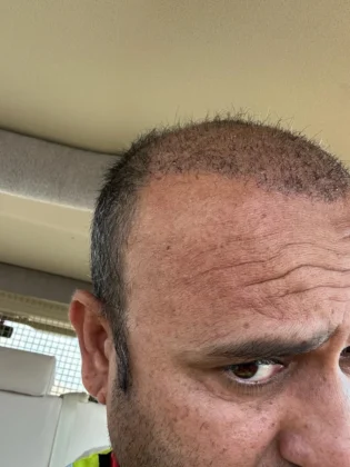 Dr. Ziya Yavuz Hair Transplant Clinic