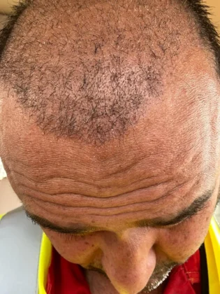 Dr. Ziya Yavuz Hair Transplant Clinic