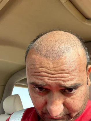 Dr. Ziya Yavuz Hair Transplant Clinic