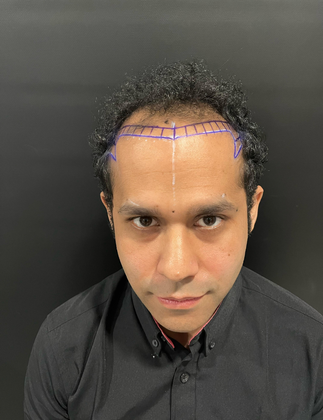 UnitedCare Hair Transplant Clinic