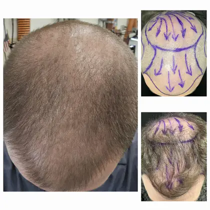 UnitedCare Hair Transplant Clinic